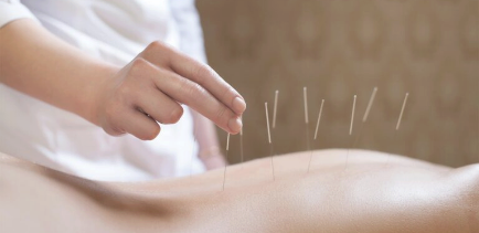 Acupuncture Acupuncture
